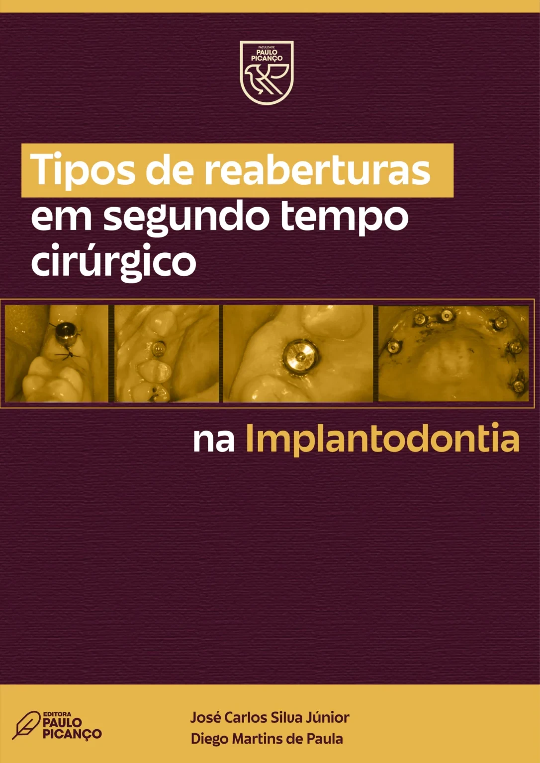 Tipos de Reaberturas em segundo tempo cirúirgico na Implantodontia 
